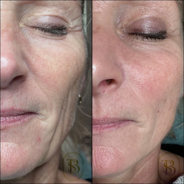 Microneedling