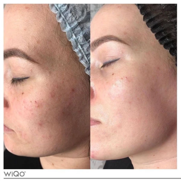 Resultaat 5x Biorepeel