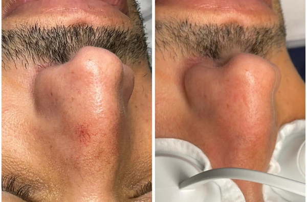 Spider Naevi resultaat